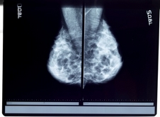 Cancer-du-sein-2
